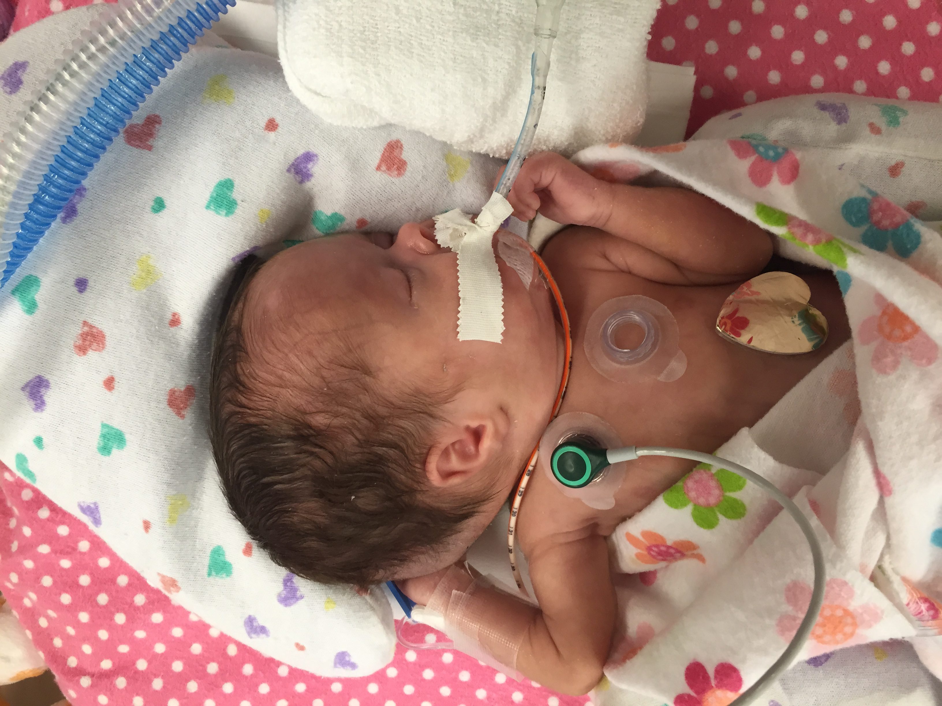 After her first shunt surgery (4lbs)