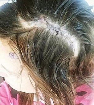 Courtney Roberge Hydrocephalus 13