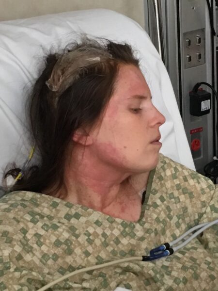 Courtney Roberge Hydrocephalus 14