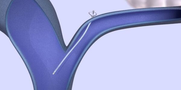 eShunt® System by CereVasc