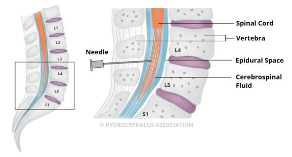 HA LumbarPuncture detail2024