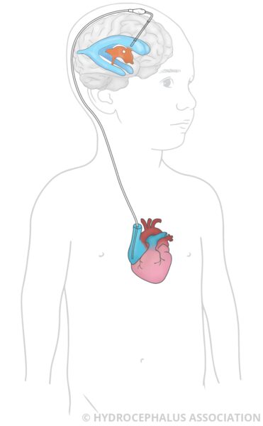 HA VAShunt ChildMale web2
