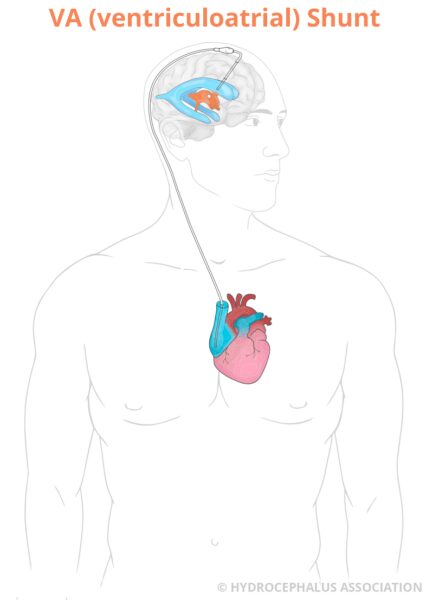 HA VAShuntAdult web Label 1