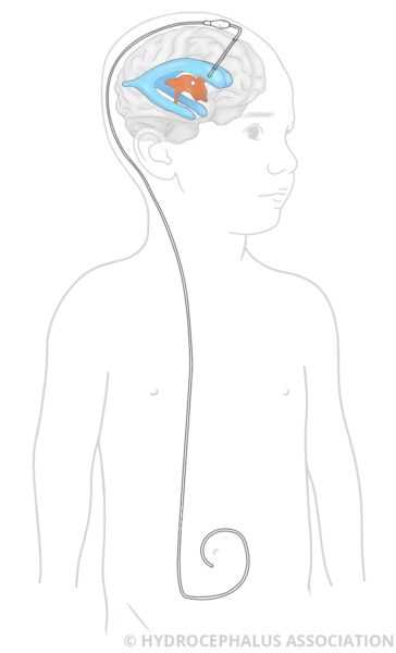 HA VPShunt ChildMale web 1