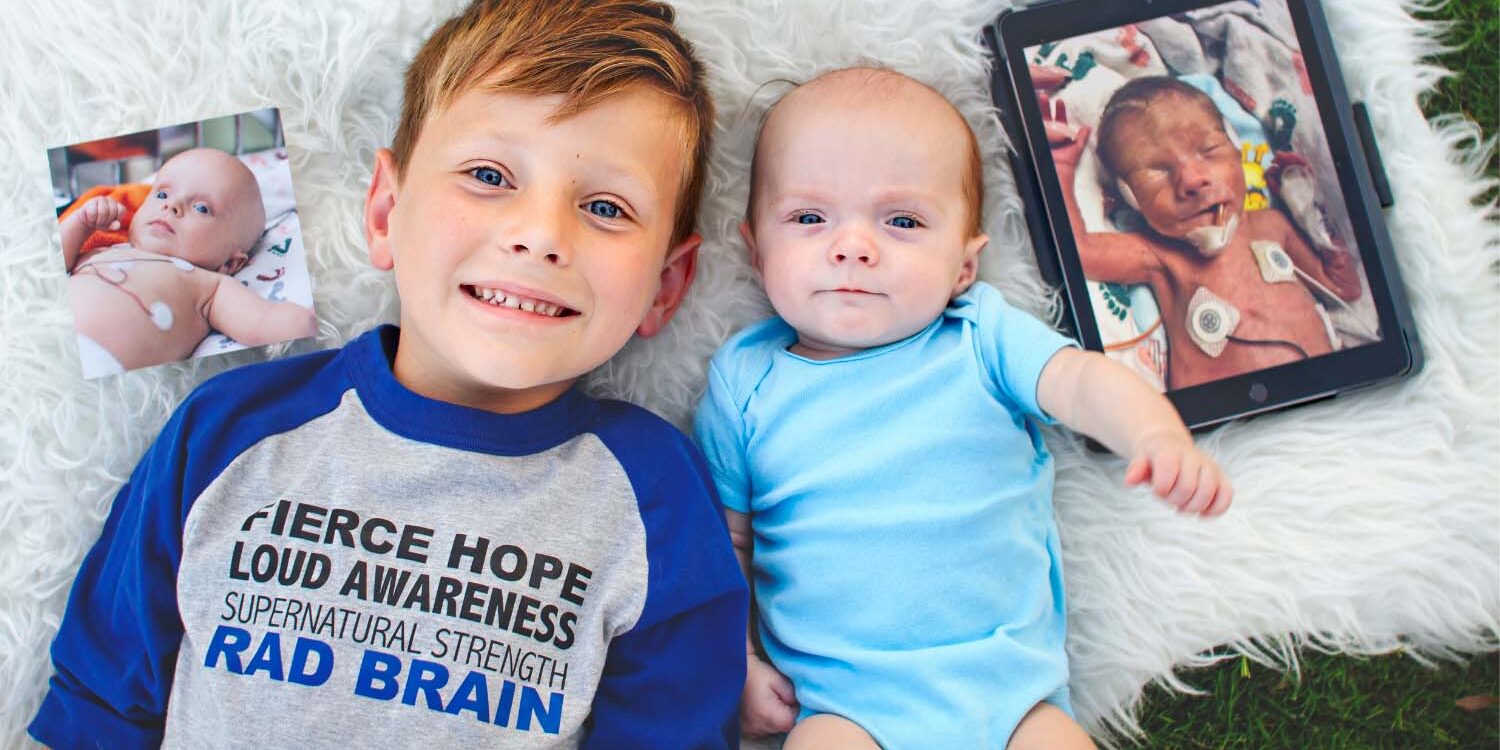 Hydrocephalus in Infants and Children image with brother and baby