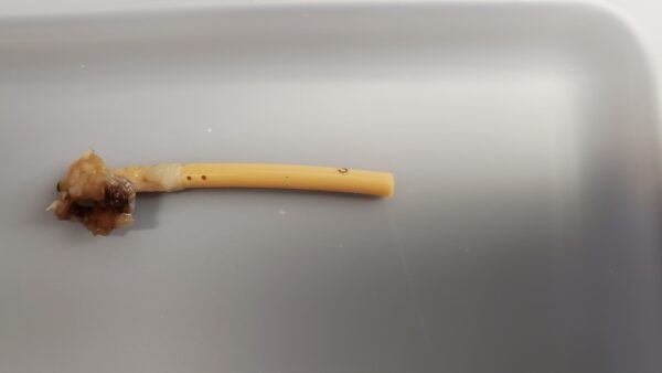 Occluded shunt Sample 1