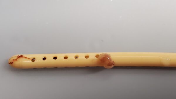 Occluded shunt Sample 4