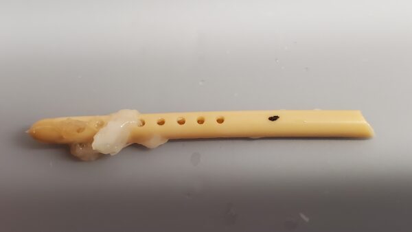 Occluded shunt Sample 7