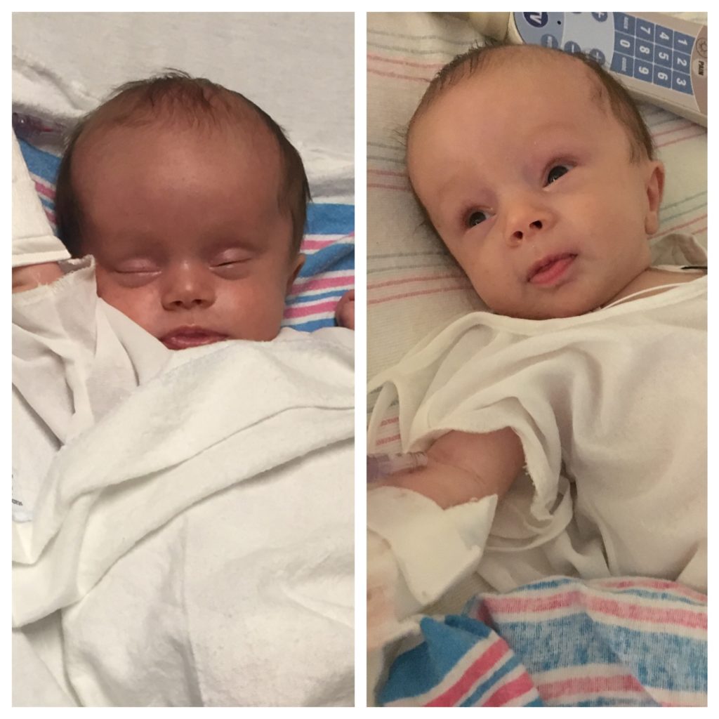 SofiaRight before and right after surgery to compare head