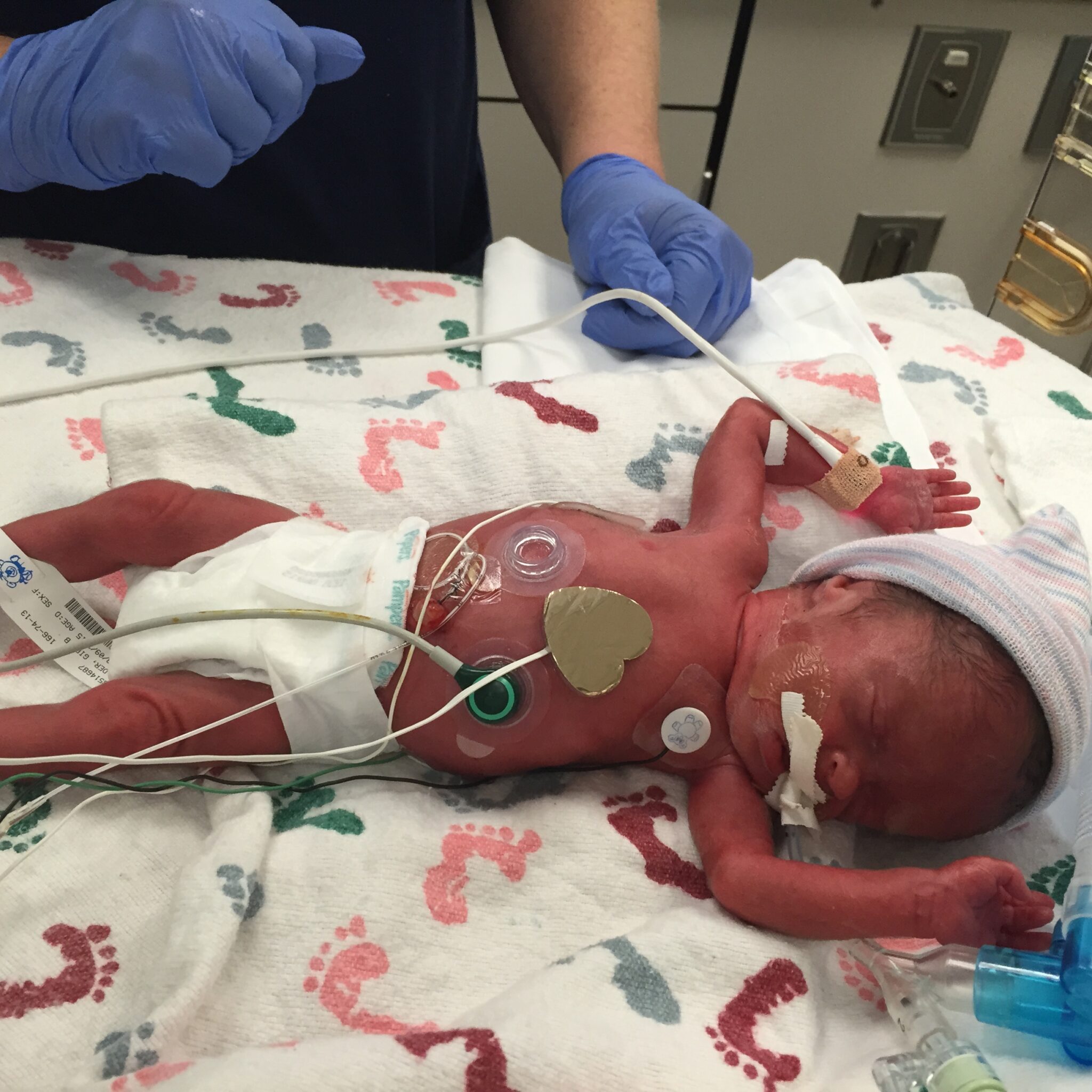 Taelley in the NICU right after delivery 3/9/15