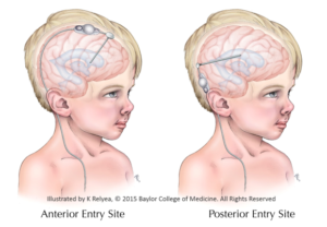 Combined Entry Sites 580x403