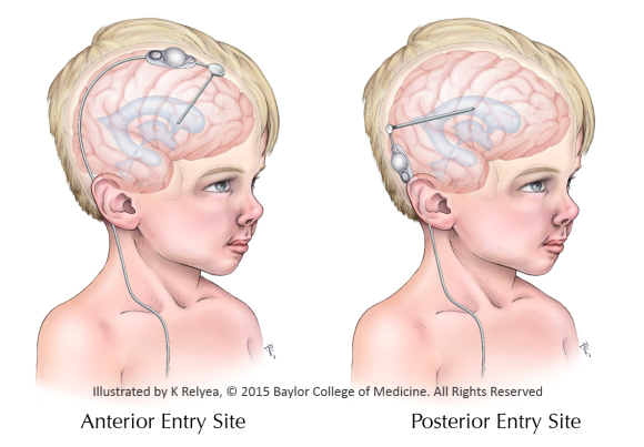 Combined Entry Sites