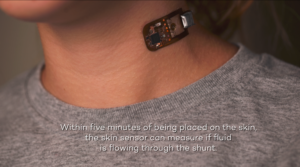 Flowsense device on neck e1638819955386