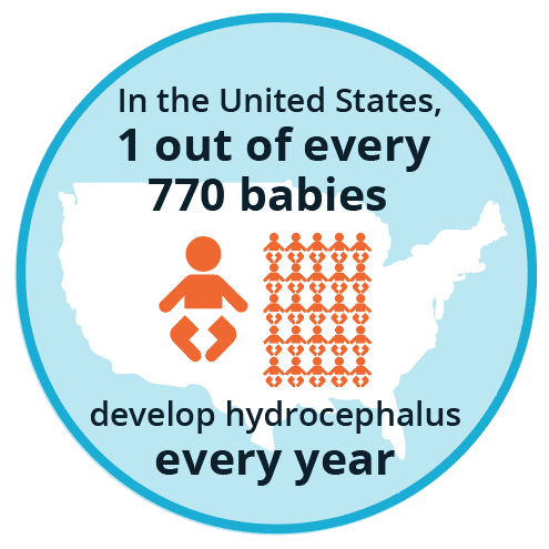 hydrocephalus in infants and children