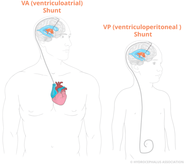 HA Ventricles VAVPShunts web Label