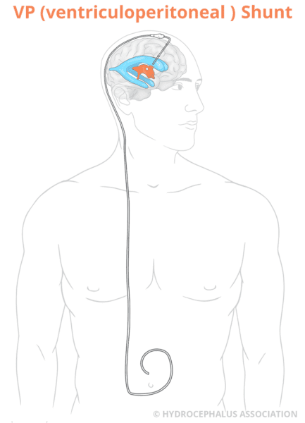 HA VPShuntAdult web Label